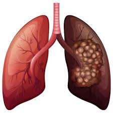 Image result for Lung Cancer