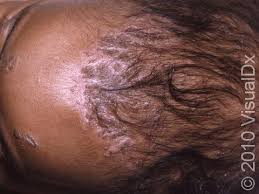 Image result for Cradle Cap