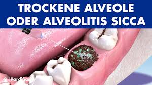 Image result for Alveolitis sicca)