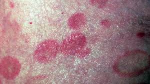 Image result for Lymphoma