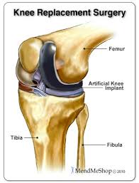 Partical Knee Replacement Knee Replacement Surgery Knee Implants Osteoarthritis