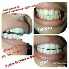 Cara menghilangkan karang gigi berikutnya yait dengan daun sirih. Propolis Elprima Msi Untuk Hilangkan Karang Gigi Dan Kesehatan Lainnya Terapi Penyakit Juga Dll Shopee Indonesia