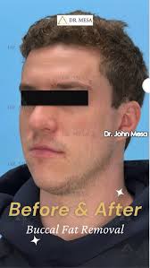 Can Buccal Fat Removal Fix a Chubby Smile and Asymmetrical Face?