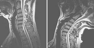 Cervical Spinal Stenosis Musculoskeletal Key