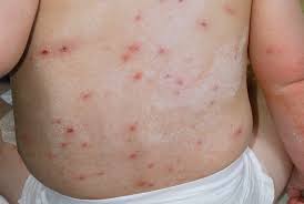 Image result for Varicella zoster on human skin