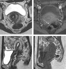 The paired uterosacral ligaments are one of the supporting structures of the uterus. Mri Atlas Of Ectopic Endometriosis Sciencedirect