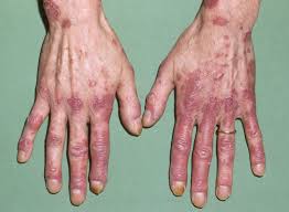 But the good news is you can get help and fight lupus. Systemic Lupus Erythematosus New Articles Lupus Sle Research