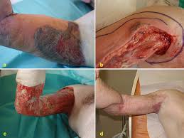 Necrotizing fasciitis is a medical emergency and should not be treated at home. Necrotizing Pyoderma Gangrenosum An Unusual Differential Diagnosis Of Necrotizing Fasciitis Journal Of Plastic Reconstructive Aesthetic Surgery