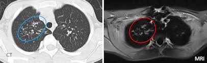 Cystic fibrosis (cf) is a genetic disease that affects your lungs, pancreas, and other organs. Mri Still No Match For Ct In Cystic Fibrosis