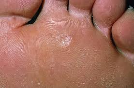 Common warts (verruca vulgaris) are benign epithelial proliferations associated with human topical vitamin a has been shown to be a successful treatment of common warts in prior informal studies. Warts Common Wart Plantar Wart Anesthesia Key