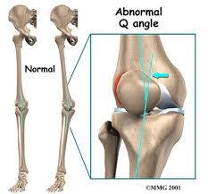 Image result for Patella Tracking Assessment