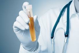 Crystals In Urine Know The Causes And Treatment