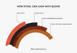 Image result for blood in stool human poop