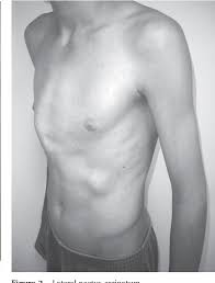 Pectus excavatum and carinatum support, photos, community, forum. Pdf Pectus Carinatum Semantic Scholar