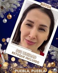 🎁 Reduce las líneas de expresión con técnica segura · $68 MXN unidad +  retoque día 10, 🎄 Valoración sin costo, 👨‍⚕️ Dr. Marco Bazán Yitani ·  Especialista