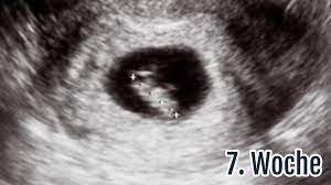 Lässt sich darauf ein embryo in einer intakten fruchtblase erkennen und eventuell schon ein herzschlag nachweisen (frühestens ab. 7 Ssw Die 7 Schwangerschaftswoche Anzeichen Ultraschall Tipps Netmoms De