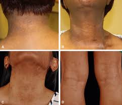 Image result for Postinflammatory Hyperpigmentation