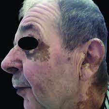 PDF) Coexistence of Vitiligo and Hyperpigmentation: A Quiz