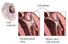 Mitral Valve Disease Frankel Cardiovascular Center Michigan Medicine