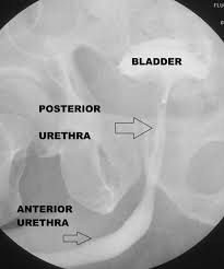 Normal Urethrogram Http Radiopaedia Org Articles Urethrography Radiology Vision Eye X Ray