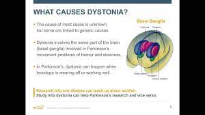Webinar Cramping More Than Your Style Dystonia Causes And Care September 2018 Youtube