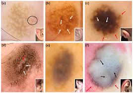 Image result for Dermoscopy