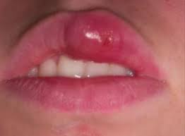 Blood blister on lip child. Blood Blister On Lip Symptoms Causes Lip Cancer Images During Pregnancy Toddler S Lip Piercing Juvederm Won T Go Away Get Rid Treatment