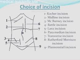 Doctordconline Different Types Of Incision Incision Surgery Surgeon Mb Surgical Technologist Student Surgical Technologist Humor Perioperative Nursing