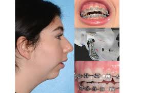 Fundraiser by Lauren Barbuzzi : Lauren's Total Joint Replacement Surgery