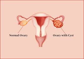 Pin On Female Infertility