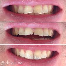 This Lovely Male Patient Asked Me If I Could Make His 11 21 Rct A Couple Of Months Ago By My Colleague Look More Oral Surgery Implant Dentistry Dentistry