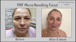Eyes that appear or are dark empty voids. Prf Facial Glow New Technology Your Own Growth Factor Youtube