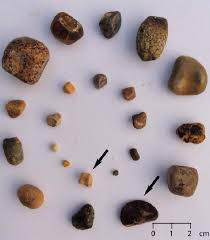 Human penises vary in size on a number of measures, including length and circumference when flaccid and erect. Picture Of Different Types Of Human Gall Bladder Stones The Stones Download Scientific Diagram