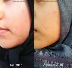 We did not find results for: Beauty Talk Pengalaman Mengatasi Purging Karena Acid Toner Beauty Blog By Rani Oktavia