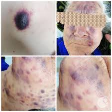 Image result for Leukemia