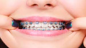 The average cost of braces for children ranges from $3,000 to $7,000 depending on a number of factors—but there are many ways to cut down on the cost and keep you and your child smiling. How Much Do Braces Cost