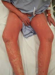 Maybe you would like to learn more about one of these? Sezary Disease Wikipedia