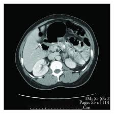 Treatment is available to help relieve this pain. Bone Metastasis As The Only Metastatic Site In A Patient With Pancreatic Cancer Following Distal Pancreatectomy