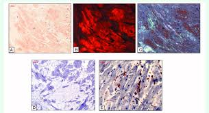 Amyloidosis is a systemic disorder that is classified into several types. Representative Images Of Al Amyloidosis A Congo Red Stain Under Download Scientific Diagram