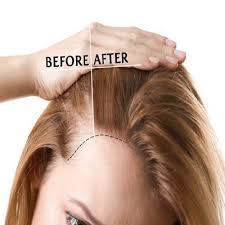 After suffering from chronic telogen effluvium for over five years, i finally decided it was time (actually way past time) to look into prp treatments for hair loss. Best Prp Hair Treatment In Dubai Abu Dhabi Sharjah Prp Therapy Cost