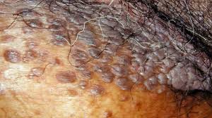 Image result for genital warts