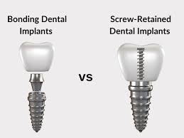 Image result for dental implant