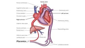 Image result for Delayed Transition from Fetal Circulation