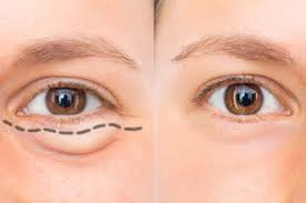 From eye makeup to full face and hair looks, the possibilities are endless for this trend just for the fact that abstract is. Eyelid Surgery Options For Improving Appearance All About Vision