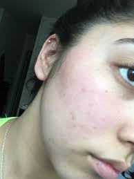 I'd guess they have some type of laser treatment or something that could help, but they'd be the best to ask. Acne How To Get Rid Of Hyperpigmentation Skincareaddiction