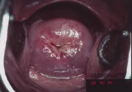 Check spelling or type a new query. Cervical Cancer Screening Aided Visual Inspection Of The Cervix Acetic Acid Test Picture Atlas Saloney Nazeer