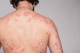 Image result for psoriasis