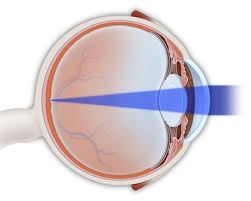 Image result for Refractive Error