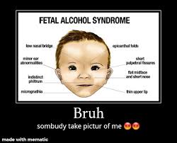 Fetal alcohol syndrome epicanthal folds flat nasal bridge small palpebral fissures upturned nose. Dis Kinda Look Like Me Tho Okbuddyretard