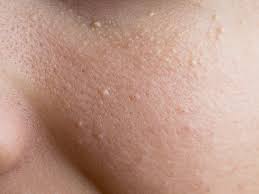 Gently make a tiny incision on the top or on the side of the milium sufficient enough to excise it. The White Bumps On The Face Are Not Acne